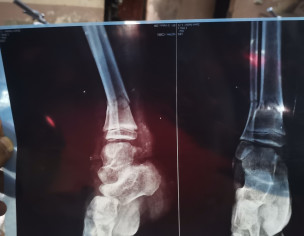 Leg Bone Broken