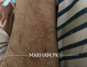 Marks On Leg