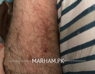 Marks On Leg