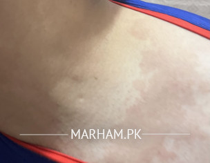 Fungal Problem On Body 