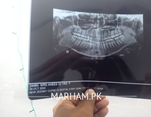 Teeth Problem OPG X-Ray