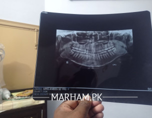 Teeth Problem OPG X-Ray