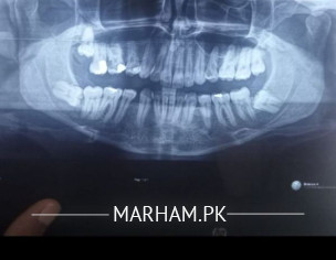 Dental Retainers / Wisdom Tooth