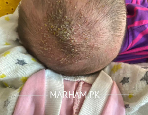 Cradle Cap