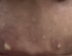 Active Acne And Acne Spots