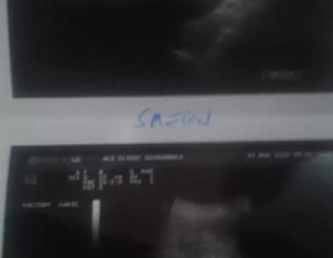 Heighly Pain In Stomack 