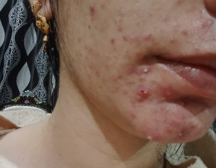Skin Acne Problem
