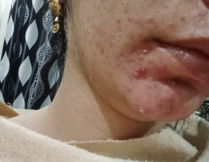 Skin Acne Problem