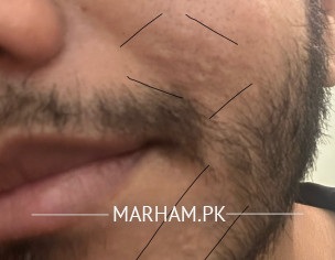 Sebaceous Hyperplasia