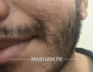 Sebaceous Hyperplasia