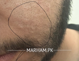 Sebaceous Hyperplasia