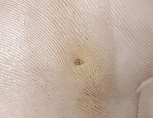 Plantar Wart