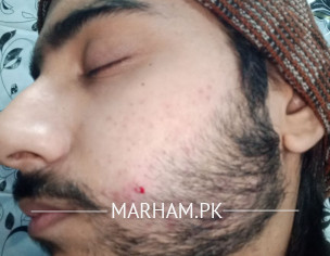 Face Acne And Acne Scars