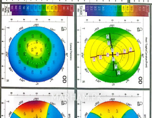 Considering Lasik Or ICL (topography Attached)