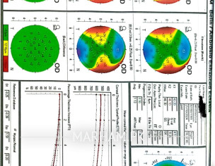 Considering Lasik Or ICL (topography Attached)