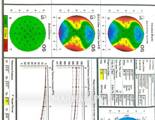 Considering Lasik Or ICL (topography Attached)