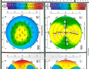 Considering Lasik Or ICL (topography Attached)