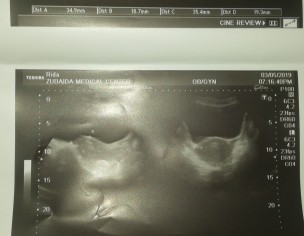 Irregular Menstrual Cycle 