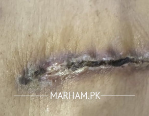 Post Bypass Surgery Problems 