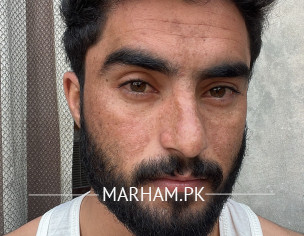 Dark Spots, Acne Black Spots