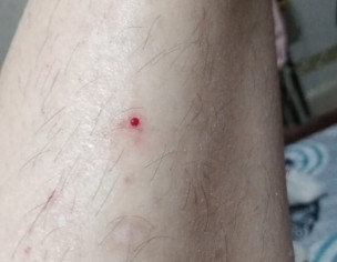 Itching Rashing On Body