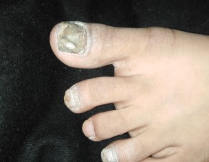 Nail Problem