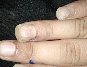 Nail Problem