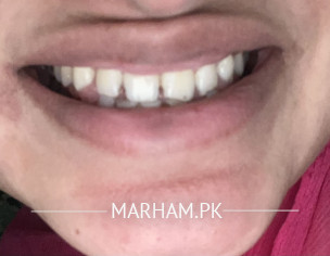 Gap Between Teeth