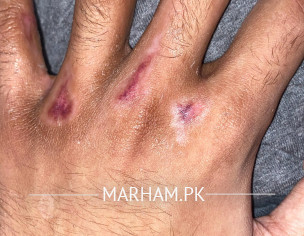 Black Scar/Spots On Hand After Accident 