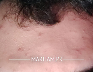 Spots On Forehead