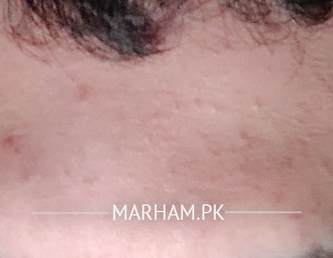 Spots On Forehead