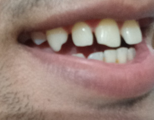 Chipped Tooth