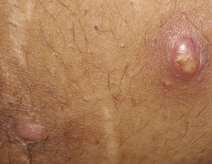 Large Pimples/boils Filled With Abscess