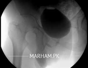 Retrograde Urethrogram