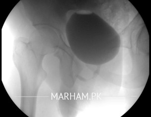 Retrograde Urethrogram