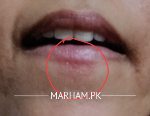 Lip Sore