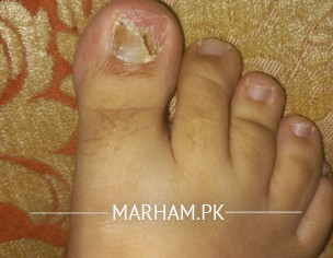 Toe Fungus