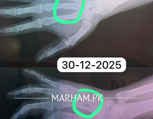 Bone Fractured (Metacarpal) Not Healing 