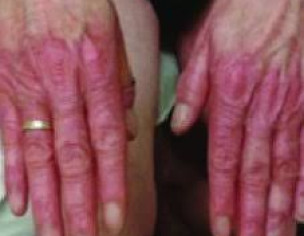 Hand Feet Skin Issue