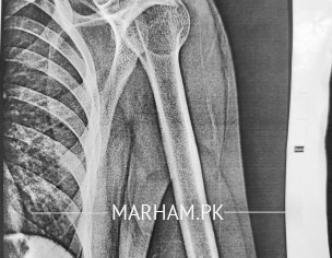 Ac Joint Dislocation