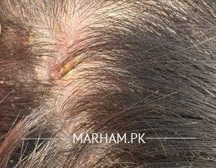 Little Bumps On Head