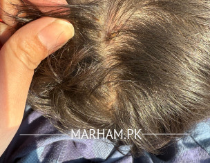 Little Bumps On Head