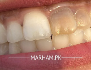Teeth Discolouration 