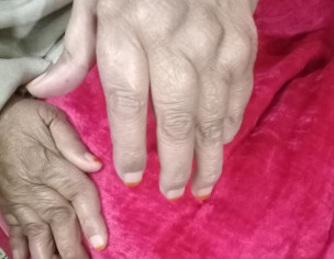 Rheumatoid Arthritis