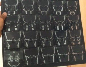 Bilateral Ethmoidal Sinusitis And Severe Head Pressure