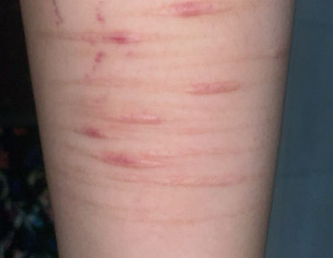 Hypertrophic Scars