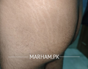 Skrech Marks White Lines On Buttocks