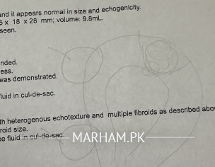 Heavy Menstruation+ Fibroid