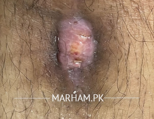 Near Knee On Tibia Wound Infection 