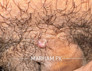 A Bump On Groin Area